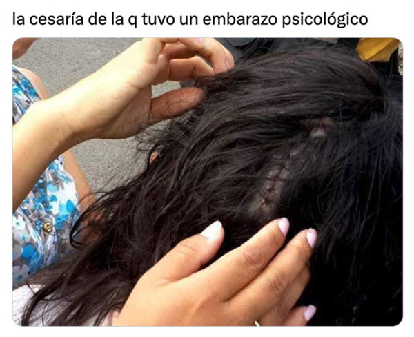 Otros - Complicaciones en el parto
