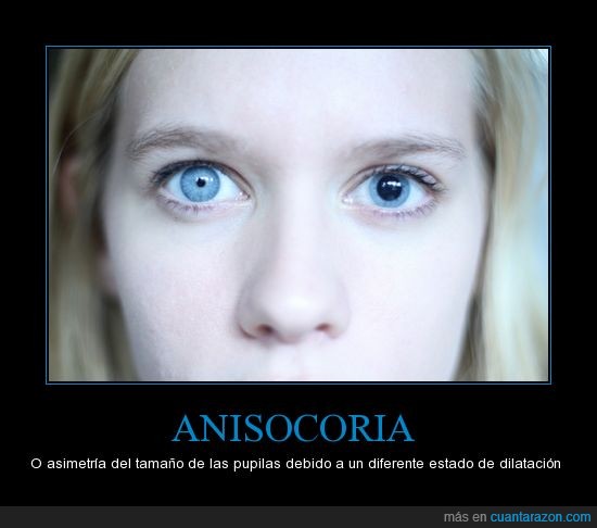 anisocoria definition