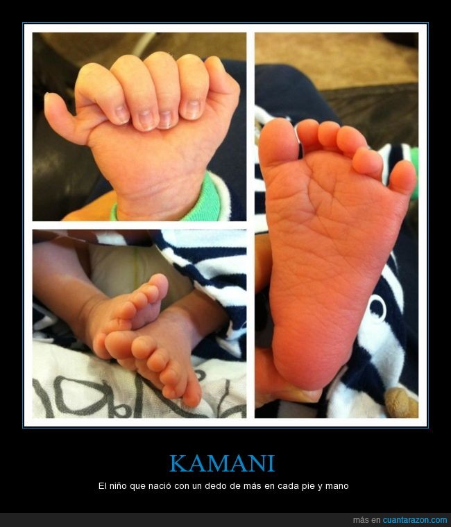 polidactilia,pies,manos,seis,dedos,pequeño,bebe,niño