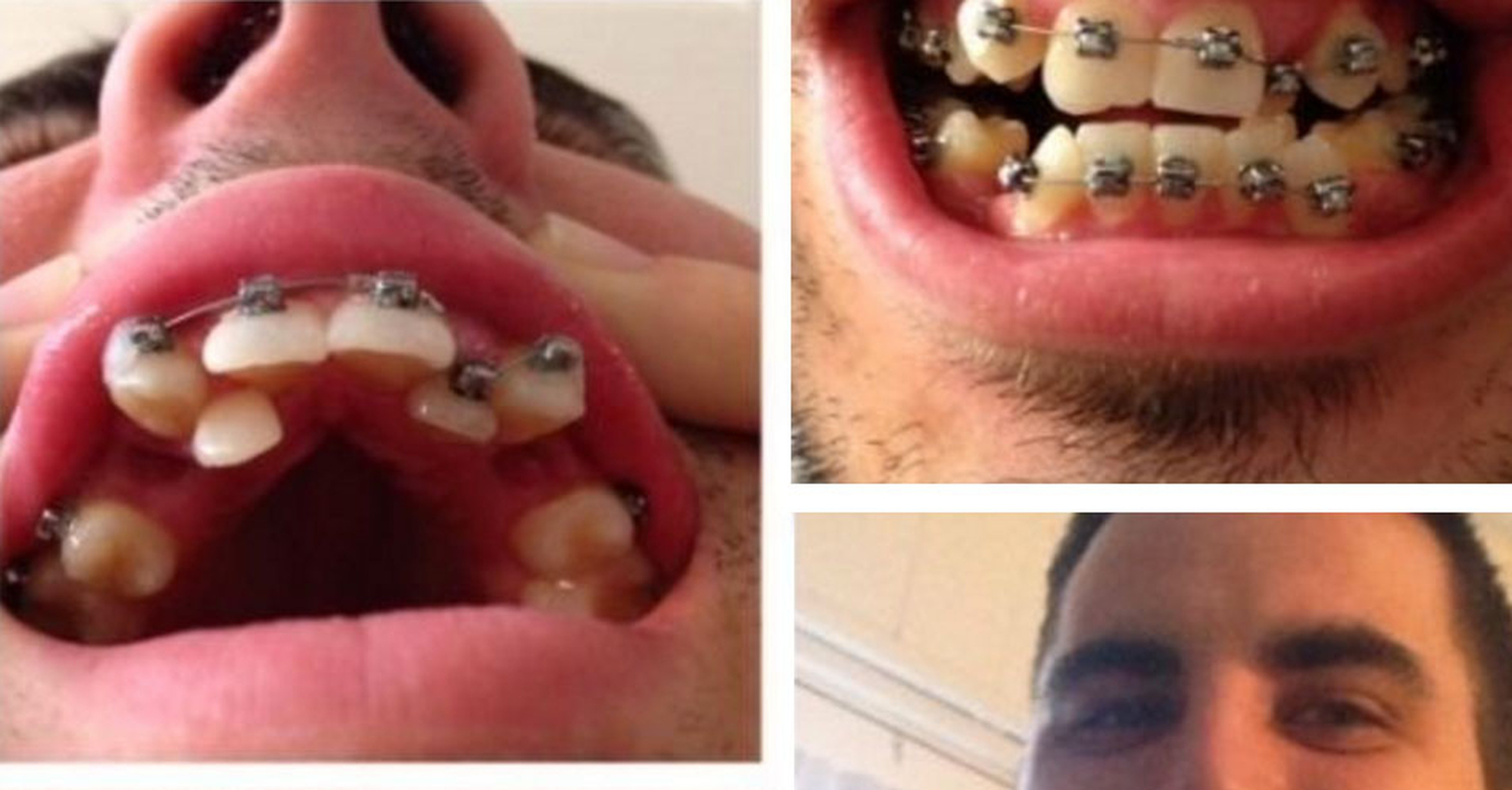 personas con varias filas de dientes