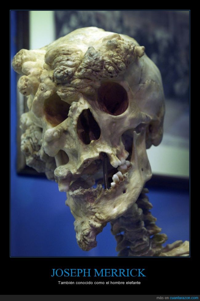 Cráneo,Hombre Elefante,Joseph Merrick,Síndrome de Proteus