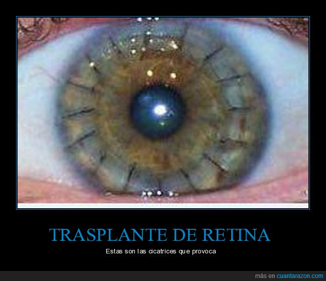 trasplante,retina,cicatrices,puntos,ojo,dolor