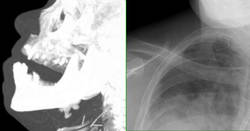 Enlace a Así de espeluznantes son las radiografías de un consumidor de heroína