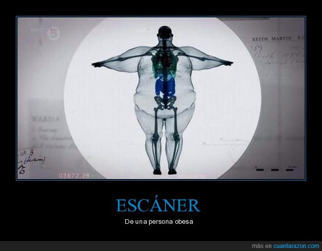 rayos x,escáner,gordo,obeso