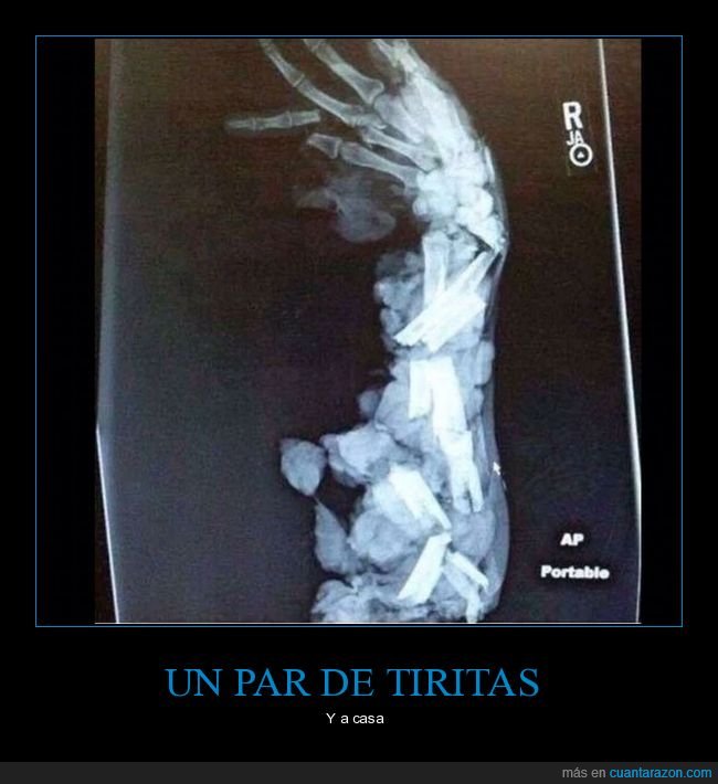 brazo,destrozado,radiografía