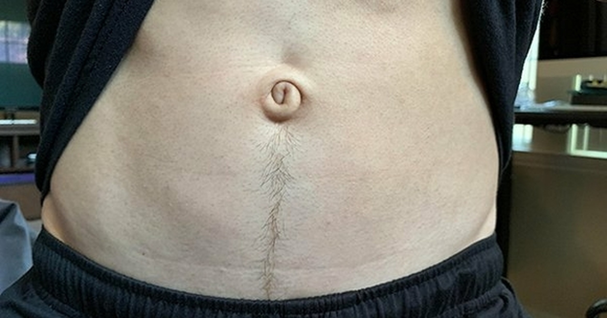 Узелки на животе. Outie belly button Ивана Петрова.