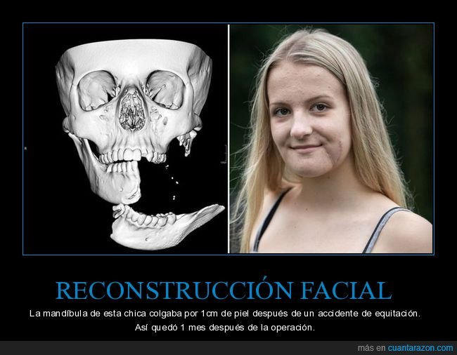 reconstrucción facial,mandíbula,operación