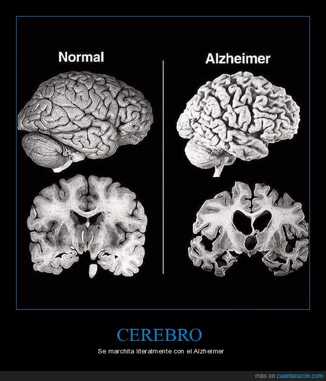 cerebro,marchitarse,alzheimer