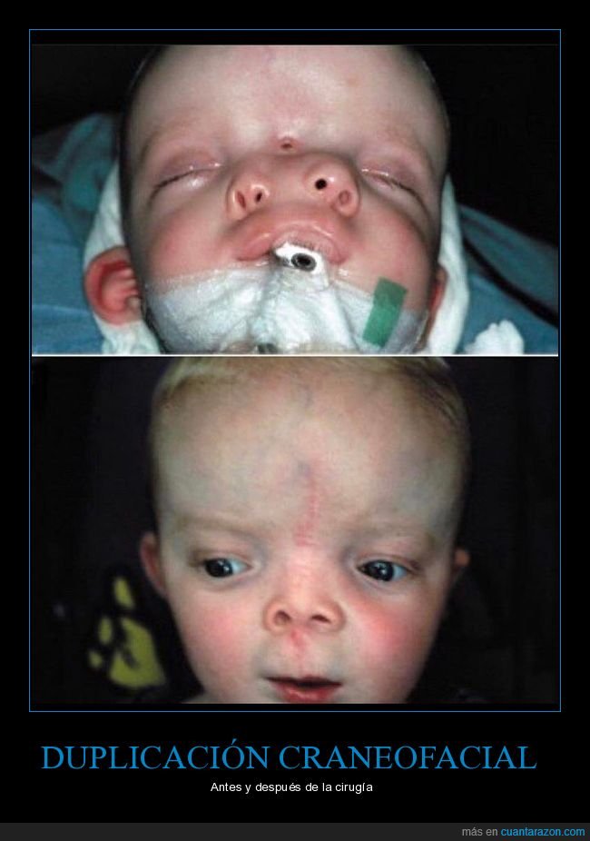 duplicación craneofacial,antes,después,cirugía