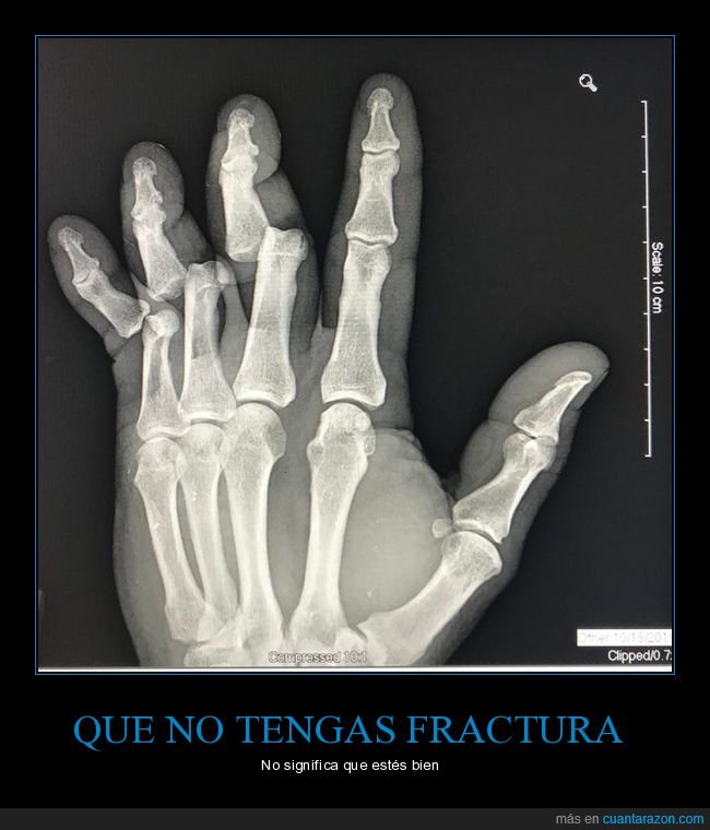 radiografía,mano,dedos,wtf