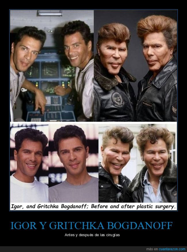 igor bogdanoff,gritchka bogdanoff,antes,despu&eacute;s,cirug&iacute;a