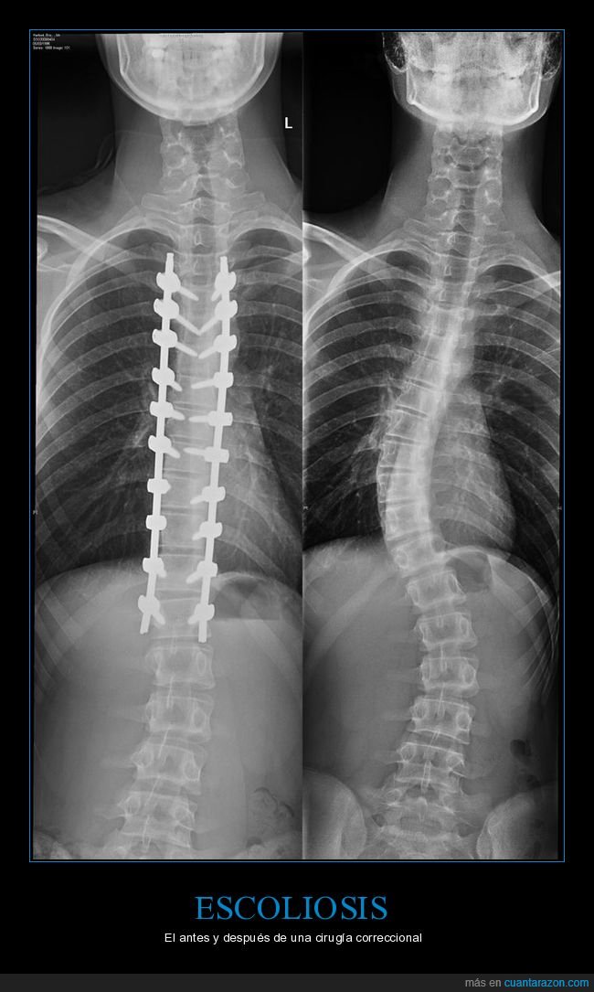 escoliosis,cirugía,columna