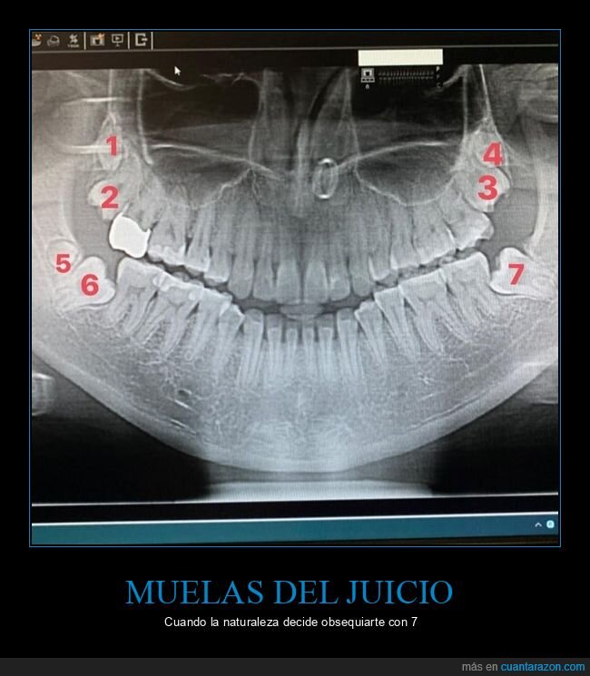 muelas del juicio,mandíbula,siete