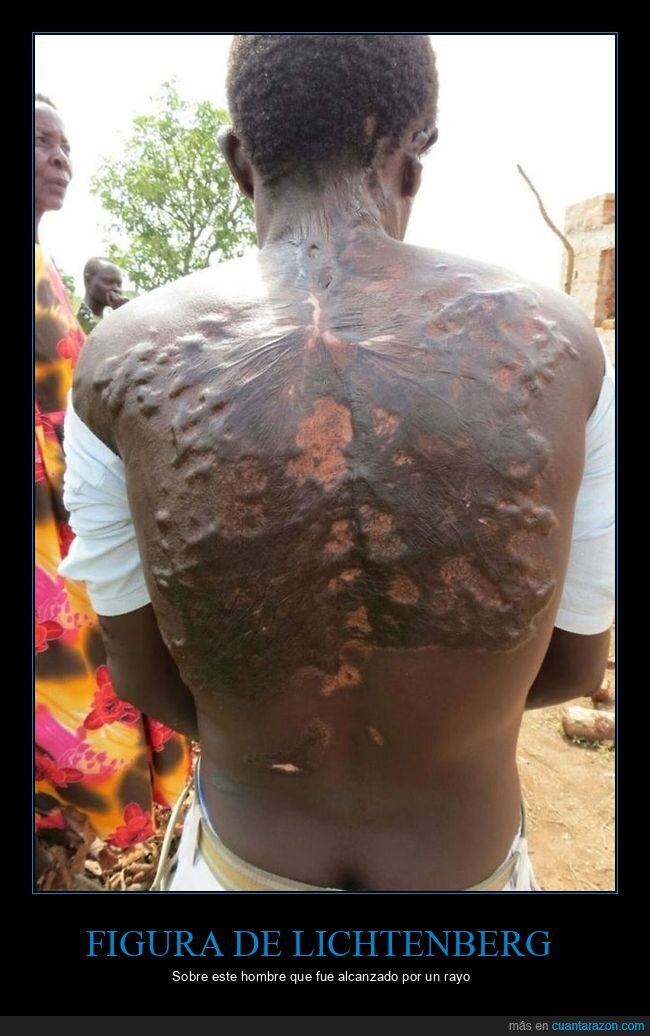 figura de lichtenberg,rayo,quemaduras