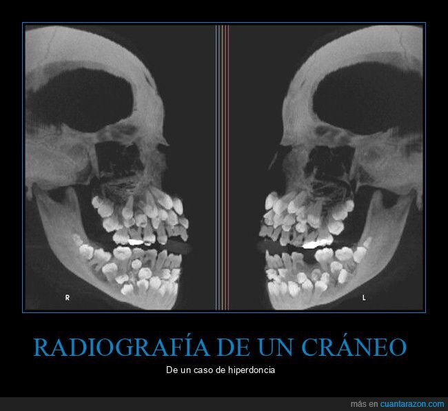 hiperdoncia,radiografía,dientes