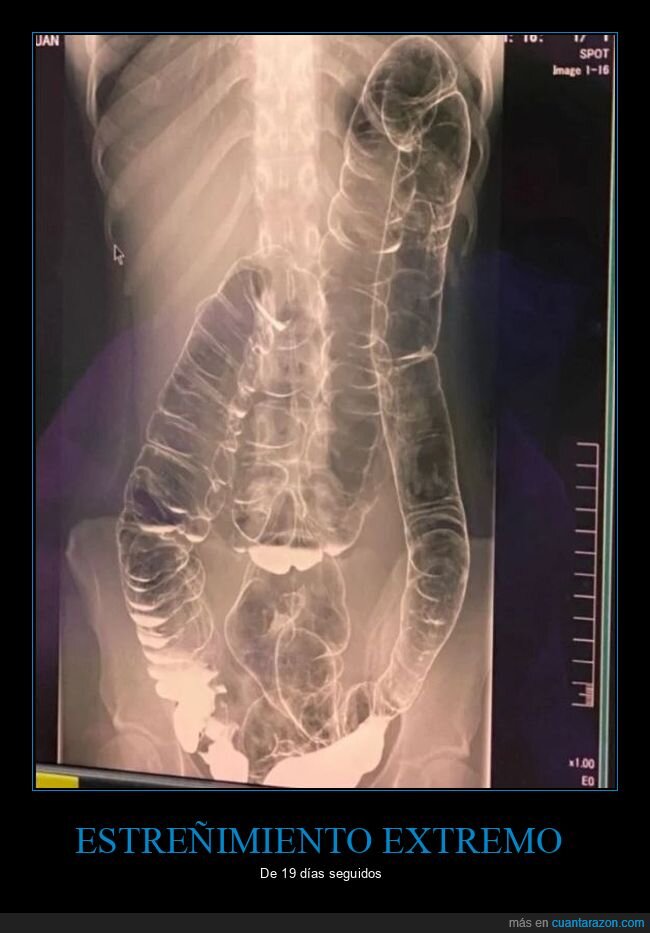 estreñimiento,radografía,wtf