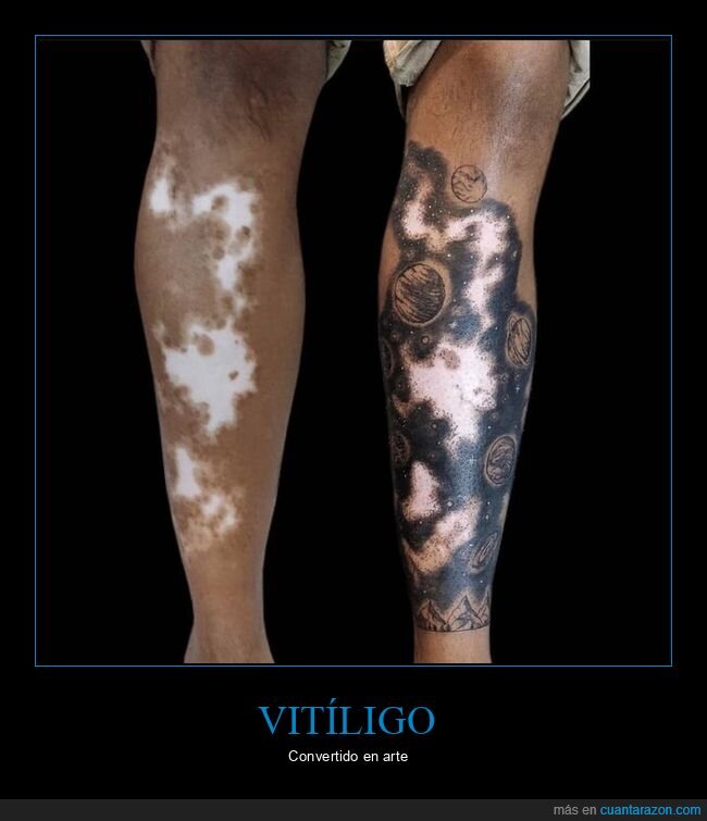 vitíligo,tatuaje