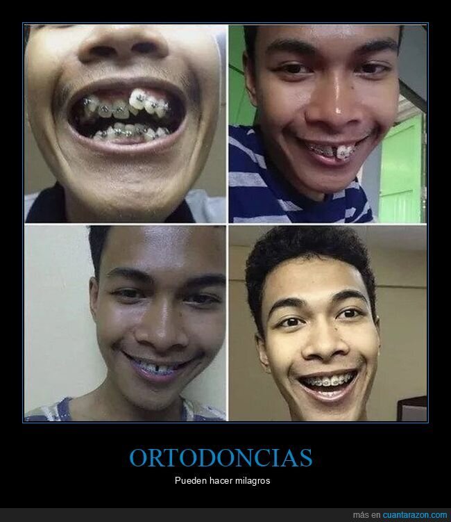 ortodoncia,dientes,antes,después