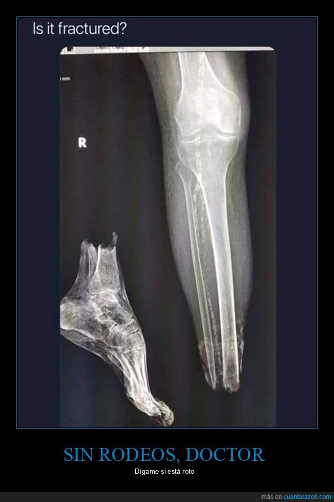 radiografía,pie,roto