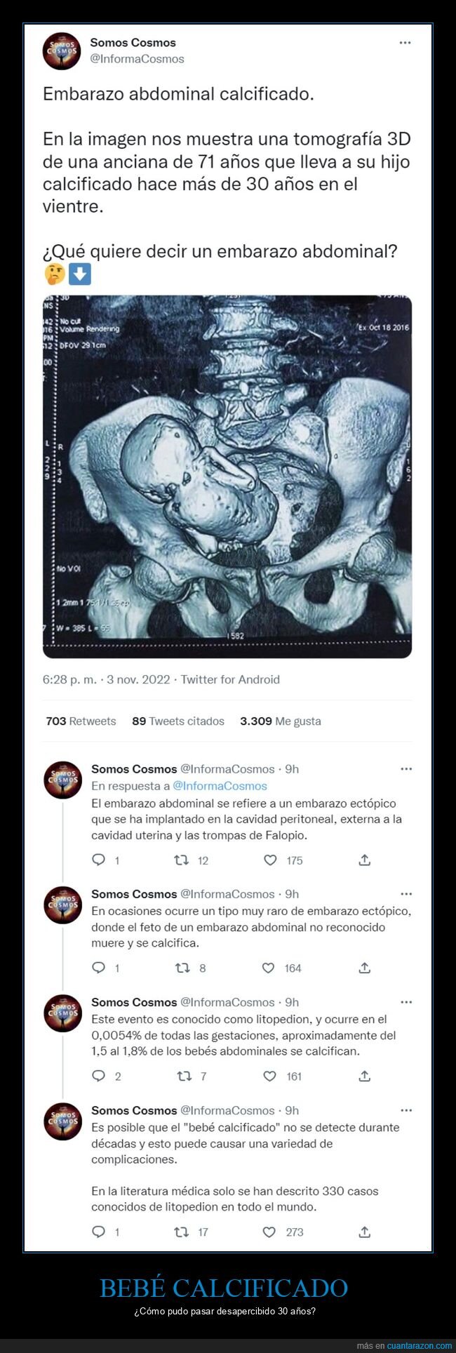 embarazo,calcificado,curiosidades