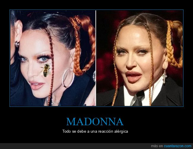 abeja,cirug&iacute;a,madonna,reacci&oacute;n al&eacute;rgica