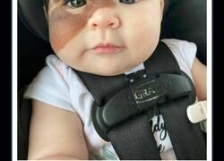Enlace a Esta bebé nació con una llamativa marca de nacimiento, y su familia lucha por normalizar su aspecto