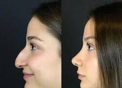 Enlace a Narices antes y después de pasar por quirófano