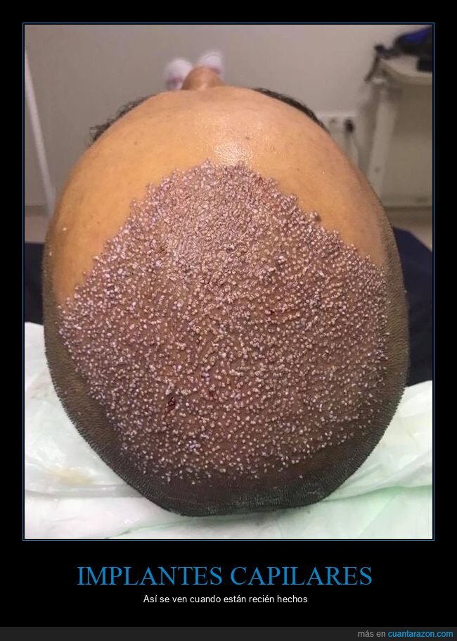 implantes capilares,recién hechos