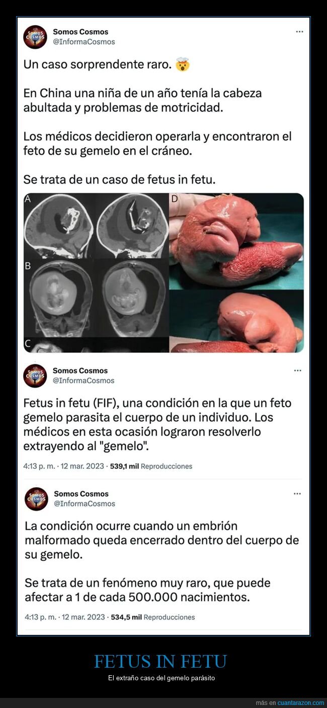 curiosidades,feto,fetus in fetu,gemelo,wtf