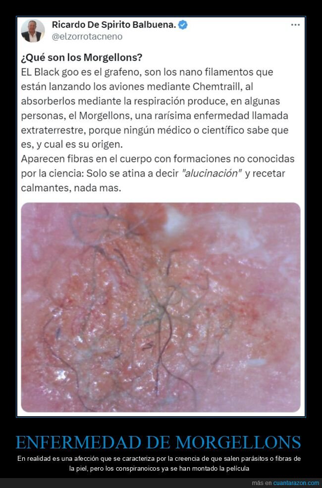 morgellons,conspiranoicos