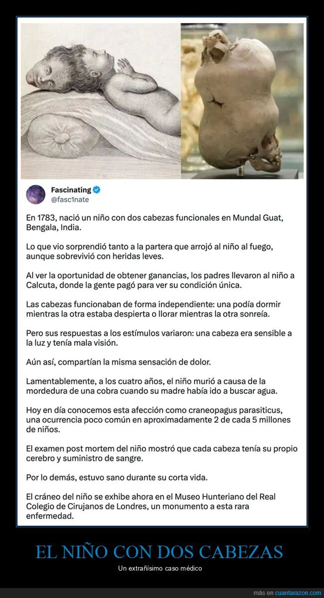 curiosidades,dos cabezas,siameses