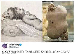 Enlace a El extraño caso del niño con dos cabezas