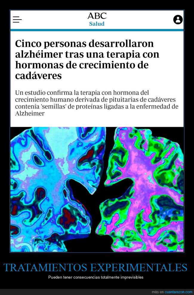 alzheimer,terapia,crecimiento,cadáveres