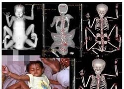 Enlace a La niña que nació con ocho extremidades