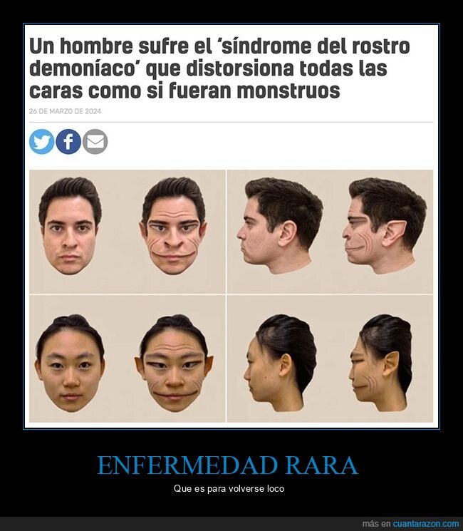 enfermedad,síndrome del rostro demoníaco