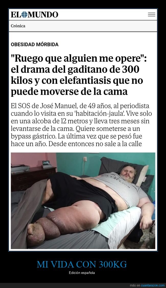300kg,obesidad mórbida