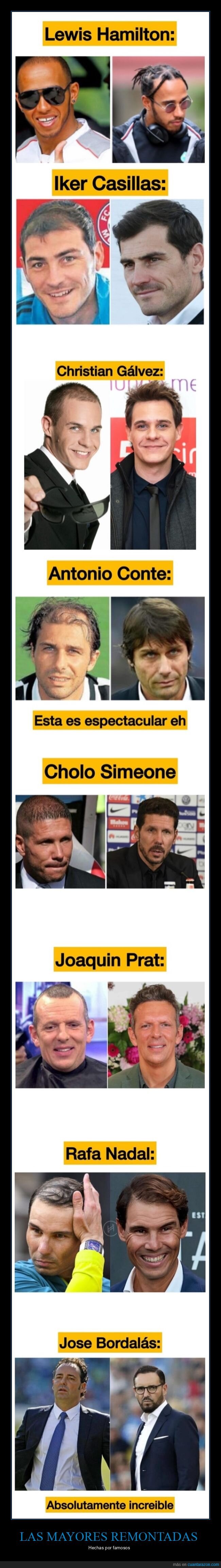 pelo,famosos,implantes