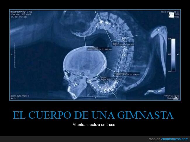 gimnasta,radiografía