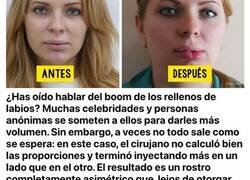 Enlace a Desastrosas operaciones de cirugía estética que acabaron con la cara de sus pacientes