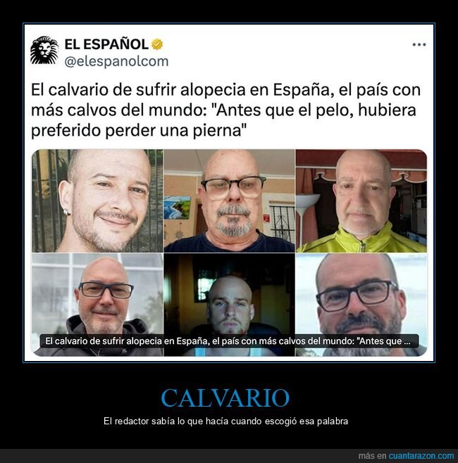 alopecia,calvario,calvos