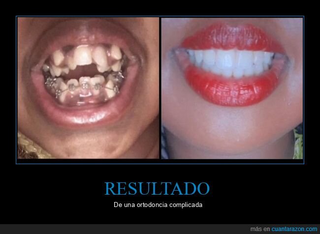 dientes,ortodoncia,antes,después