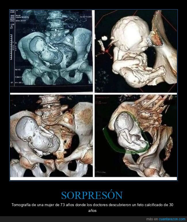 feto,calcificado,esqueleto,hijo,dep