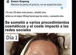 Enlace a Los resultados del lifting facial que se hizo esta mujer por 15000$ han alucinado a todo internet