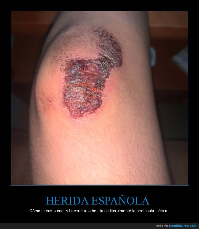 rodilla,península ibérica,español,dolor,herida