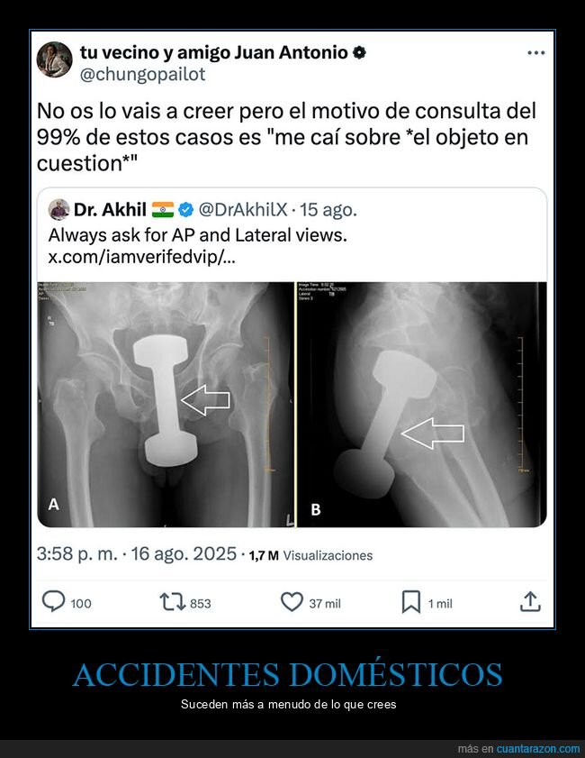 caerse,radiografía