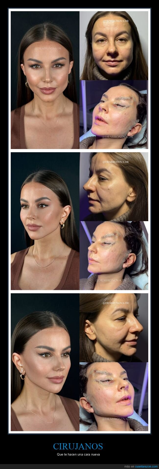 cirugía,antes,depués