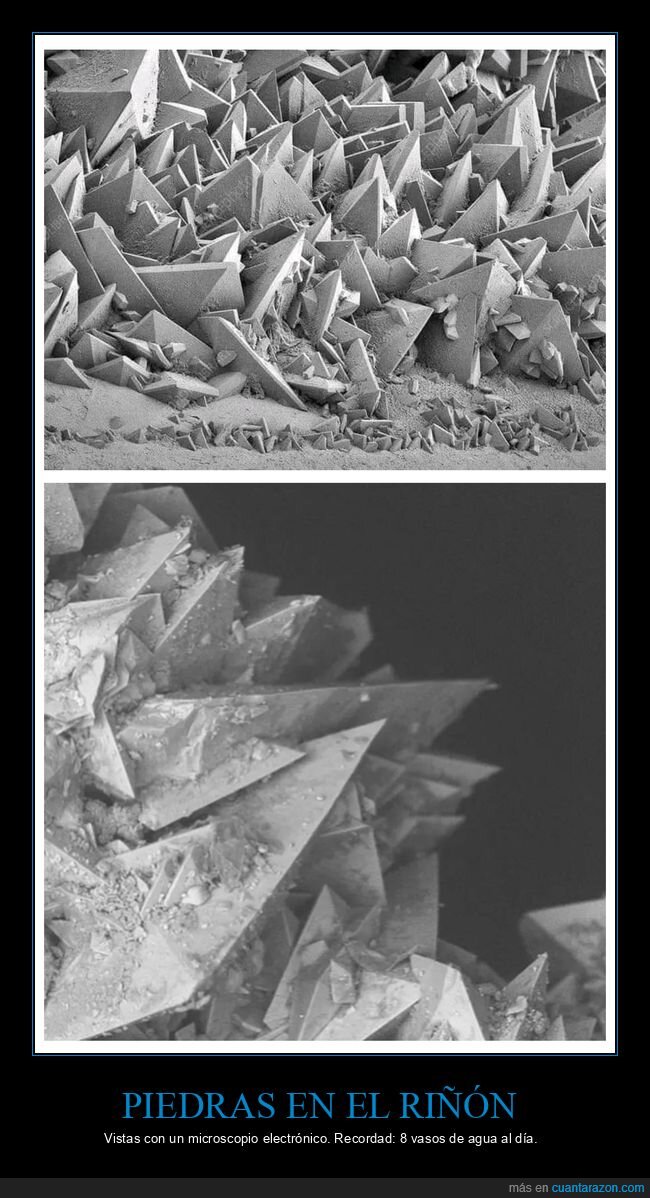 piedras en el riñón,microscopio electrónico