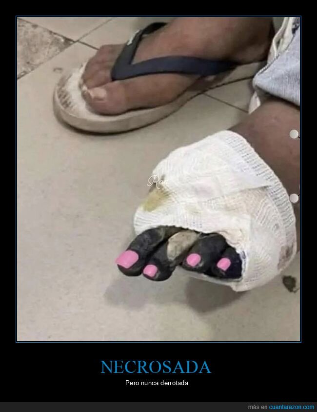 dedos,necrosis,pintadas,uñas