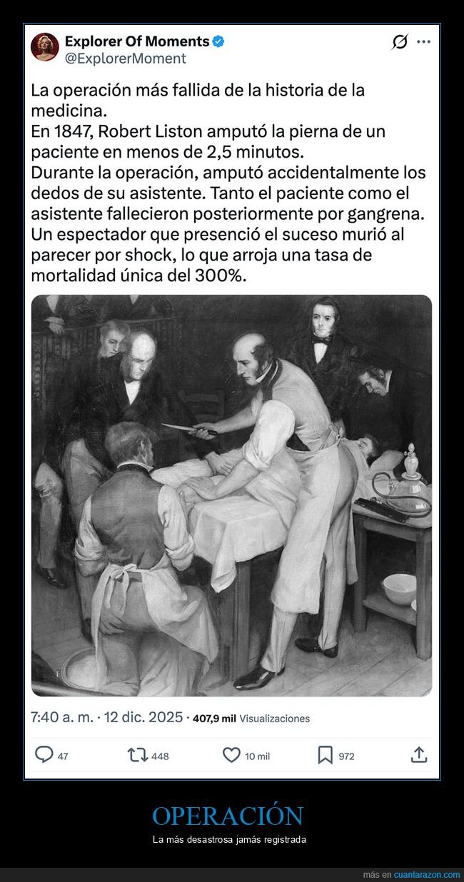 curiosidades,fails,operaci&oacute;n,robert liston