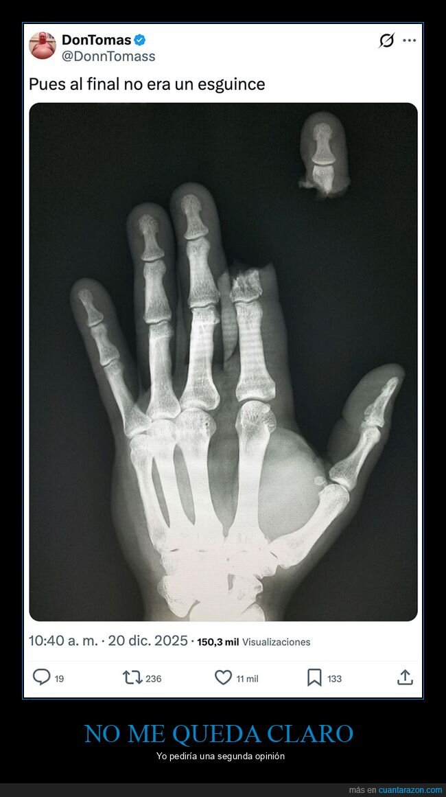 dedo,mano,radiograf&iacute;a